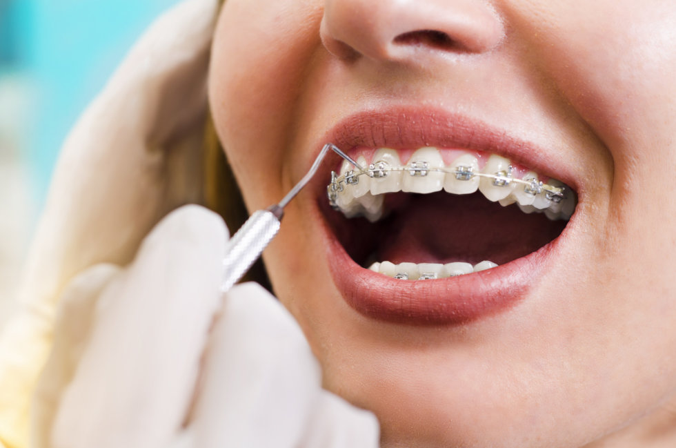 Telltale Signs You Need Braces Creekside Orthodontics