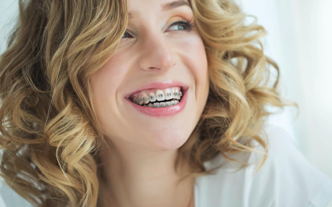 What to Expect When Getting Braces as an Adult