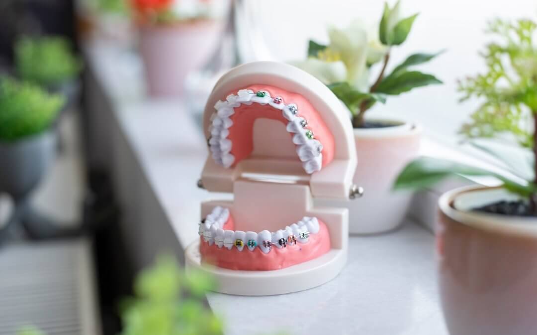 Exploring Your Orthodontic Treatment Options at Creekside Orthodontics in Billings, MT