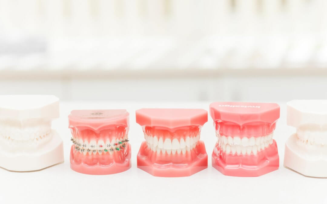 Alternatives to Traditional Braces in Billings, Montana