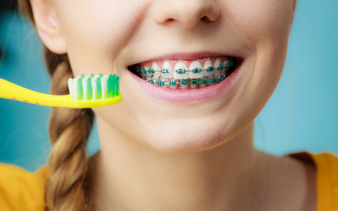 How to Brush Teeth with Braces: Tips from Creekside Orthodontics