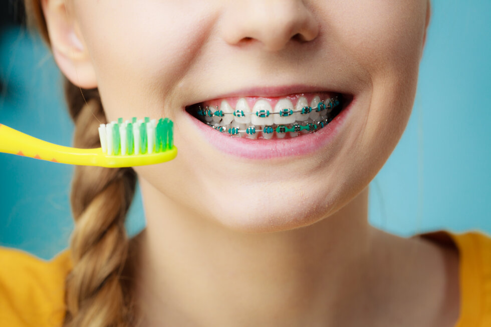 How to Brush Teeth with Braces Tips from Creekside Orthodontics